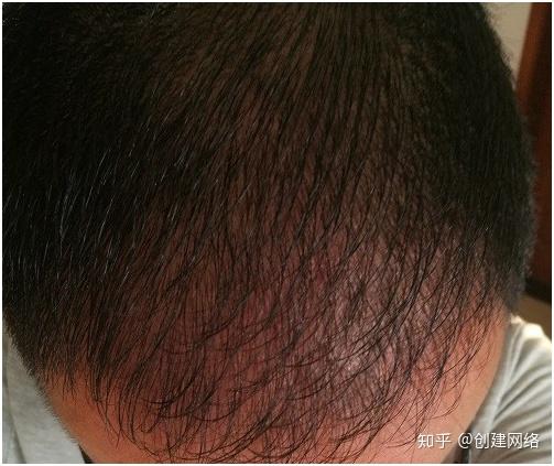植发真的有用吗？可以维持多久？探究植发的真实效果与持久性植发有用吗可以维持多久百度碧 莲盛不错